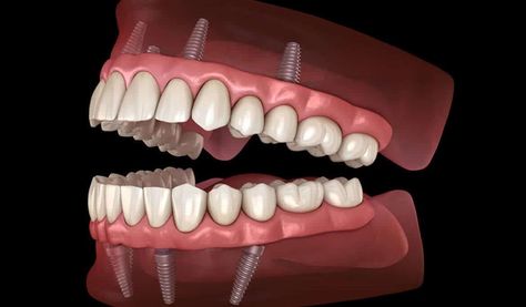 Free Dental Implants, Affordable Dentures, Affordable Dental Implants, Dental Implant Procedure, Denture Implants, Dental Implant Surgery, Dental Implants Cost, Human Teeth, Tooth Replacement