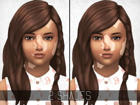 SimplyPixelated - Vitiligo Overlay - Child/Toddler Vilitigo Sims 4 Cc, Sims 4 Vilitigo Skin, Vilitigo Skin Sims 4 Cc, Sims 4 Vilitigo Cc, Sims 4 Cc Vilitigo Skin Details, Vilitigo Skin, Sims 4 Cc Vilitigo Skin, Sims 4 Vitíligo Cc, The Sims 4 Kids