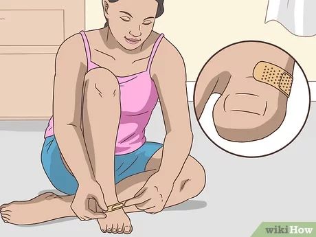 4 Ways to Treat a Foot Blister - wikiHow How To Get Rid Of Blisters On Feet Fast, How To Heal Blisters On Feet Fast, Blisters Remedies, How To Treat Blisters, Water Blister, Blister Remedies, How To Heal Blisters, Blister Care, Skin Blisters