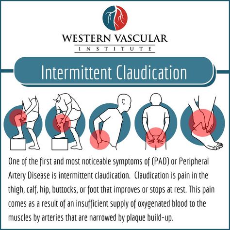 Intermittent Claudication and Peripheral Artery Disease (PAD) #peripheralarterydisease #vasculardisease #legpain #claudication #vascularsurgery #vascularsurgeon #atherosclerosis #artery Peripheral Artery, Crna School, Vascular Surgery, Med Surg, Leg Pain, Nursing Notes, Cardiovascular Health, Phoenix Arizona, Phoenix Az