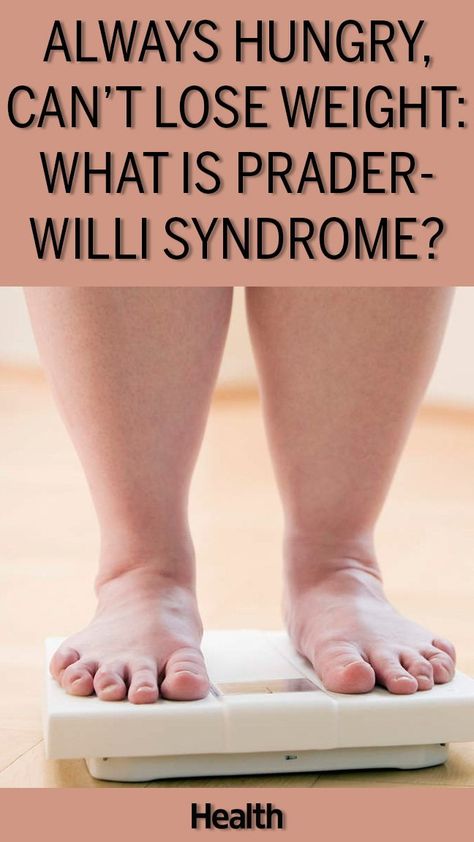 Prader-Willi sydrome is a condition that makes you hungry all the time. Being constantly hungry is a sign that you could have Prader-Willi syndrome. See the pageant queen with Prader-Willi syndrome who won her competition. Lifespan Development, Short Fingers, Prader Willi Syndrome, Workouts For Fat Loss, Exercise Hacks, Constantly Hungry, Athleisure Inspiration, Different Goals, Hungry All The Time