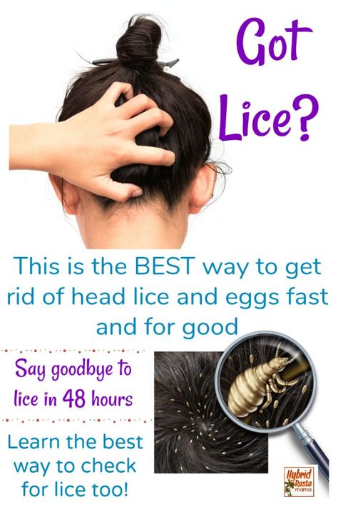 Get rid of lice with coconut oil Home Lice Remedies, Natural Lice Remedies, Lice Remedies, Lice Shampoo, Hair Lice, Lice Prevention, Health Coconut Oil, Lice Eggs, Lice Removal