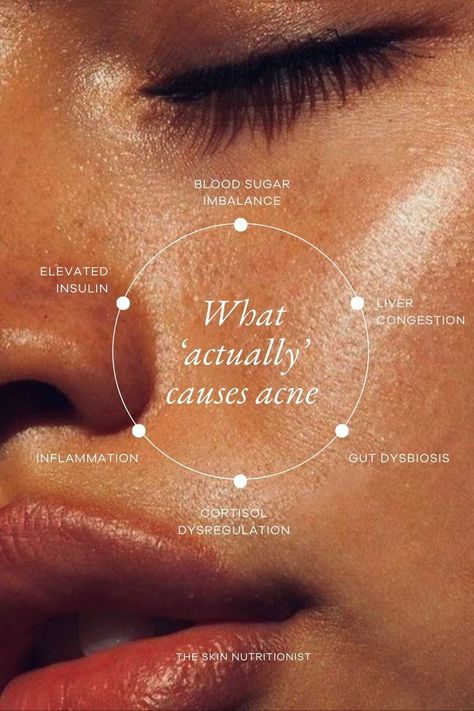 What Really Causes Acne?? Acne Before And After, Cause Of Pimples, Acne Around Mouth, Eyebrow Acne, Acne Between Eyebrows, At Home Skin Treatments, Causes Of Migraine Headaches, Aesthetics Nurse, Skin Treatments For Acne