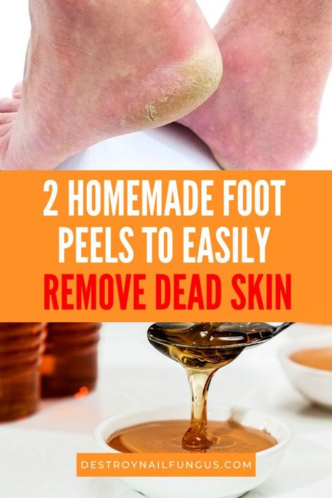 10 Quick and Easy DIY Foot Peel Recipes That Actually Work Diy Foot Peel, Homemade Foot Cream, Dry Feet Remedies, Foot Mask Peel, Foot Scrub Recipe, Homemade Foot Scrub, Diy Foot Soak, Dead Skin Removal, Foot Soak