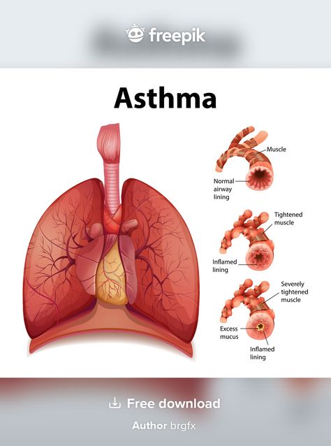 Throbbing Headache, How To Help Nausea, Severe Asthma, Healthy Lungs, Chronic Obstructive Pulmonary Disease, Asthma Symptoms, Healthy Morning Routine, Pulmonary Disease, Lung Disease