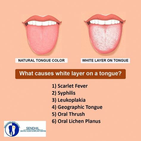 What Your Tongue is Trying to Tell Tongue Cleaning, Lichen Planus, White Tongue, Tongue Health, Tongue Cleaner, Nail Care Tips, Pelvic Pain, Keto Meal, Week 1