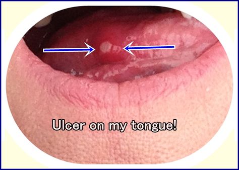 Home Remedies for Mouth Ulcers Sore Tongue Remedy, Tongue Ulcer Remedies, Sore On Tongue Remedy, Mouth Blister Remedy, Ulcers In Mouth, Blister On Tongue, Sore In Mouth Remedies, Canker Sore On Tongue, Types Of Mouth