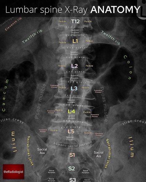 Radiology Notes, Picture Of Body, Medical Radiography, Medical Images, Radiology Student, Radiology Imaging, Lumbar Spine, Ultrasound Tech, Pa School