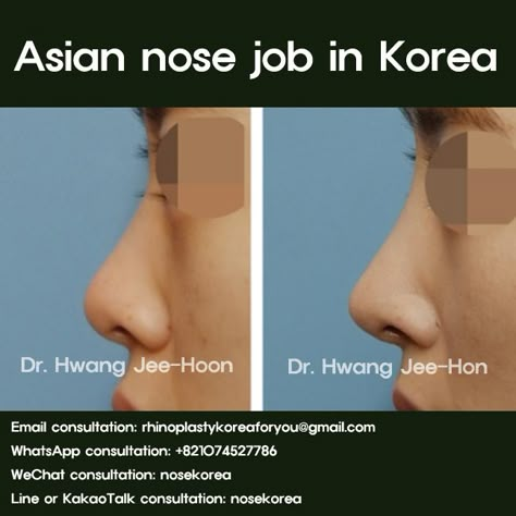 Asian people commonly has flat, wide and big nose.  It is a traditional nasal shape, however, as time goes, many of Asian began to like higher and sharp nose.  Because, as many people getting use Instagram, face-book and YouTube, they started to want to have better facial profile at their photos and videos.  When has higher nose, facial line become more dimensional profile  #asiannosejob #aisan_nose_job #nosejob #nose_job_korea #asian_rhinoplasty #asianrhinoplasty #rhinoplasty #rhinoplastykorea Flat Nose Asian, Asian Nose Job, Korean Nose Job, South Korean Plastic Surgery, Tip Plasty, Asian Nose, South Korea Beauty, Ethnic Rhinoplasty, Korean Plastic Surgery