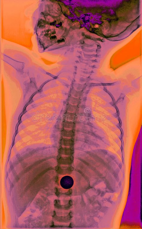 Color X-ray Art, Child 1. This is a colorized x-ray of a child who swallowed mon , #sponsored, #colorized, #swallowed, #child, #ray, #Color #ad Brain Xray, X Ray Art, Projector Background, Evil Flower, Medicine Art, Baby Technology, Xray Art, Disco Elysium, Ray Film