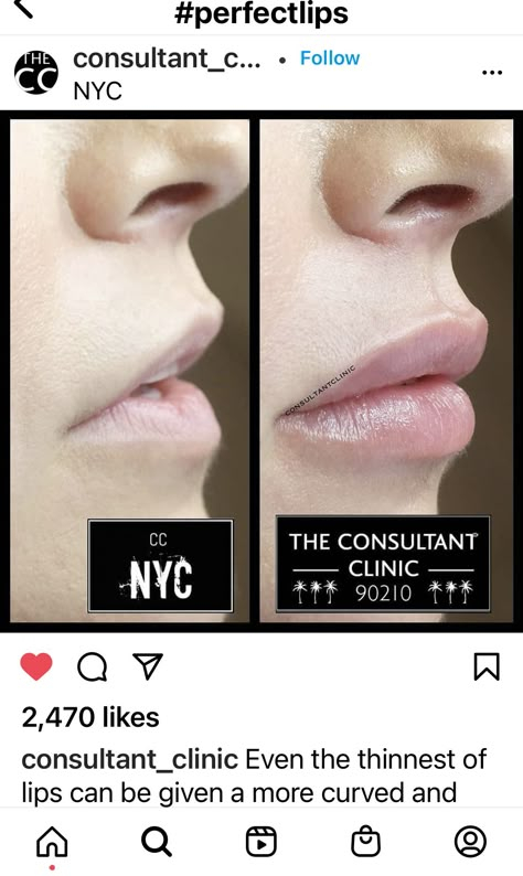 Very Natural Lip Filler, Angelic Lip Filler, Lip Filler Downturned Lips, Lip Filler Smile Before And After, Flat Lips Filler, 0.5ml Lip Filler Before And After, Lip Filler Inspiration, 1ml Lip Filler, Lip Flip