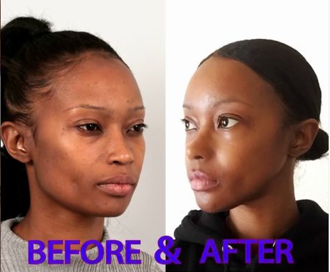 Click to read her story. She had Forehead reduction, Rhinoplasty, V-line surgery, Cheekbone reduction and Fat graft in ID Hospital.  #idhospital #cheekbonereduction #fatgraft #mommymakeover #vline #vlinesurgery #rhinoplasty #plasticsurgerinkorea #plasticsurgerybeforeafter #koreanplasticsurgery #antiaging #transformation #transformationpicture Face Contouring Surgery, Reduction Rhinoplasty, Perfect Forehead, Cheekbone Reduction, Forehead Reduction, Look More Feminine, V Line Surgery, Ethnic Rhinoplasty, V Line Face