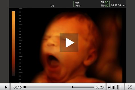 What is A 4D Ultrasound Scan 4d Ultrasound Pictures, 3d Ultrasound Pictures, Gender Reveal Ultrasound, Baby Bedside Sleeper, 3d Ultrasound, 4d Ultrasound, Baby Ultrasound, Baby Scan, Ultrasound Pictures