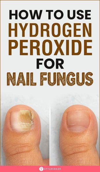 Symptoms of nail fungus vary in severity and may include: Nail discoloration (white, yellow, or brown). Nail thickening. Nail cracking. Nail fragility. Nail distortion. Nail pain (in severe cases). Slight foul odor. Fungal skin infection of the foot, commonly between the toes (may accompany a fungal toenail infection). While fungal nail infections can infect fingernails and toenails, toenails are more commonly affected. |Feet nails |feet pictures |feet pics |feet care Penny Ball, Toenail Health, Nail Remedies, Peroxide Uses, Toenail Fungus Remedies, Nail Fungus Remedy, Nail Infection, Holistic Diet, Fungal Nail