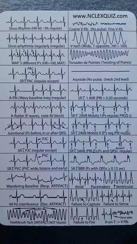 EKG Heart Rhythms Cheat Sheet EKG Heart Rhythms Cheat Sheet Ekg Rhythms, Paramedic School, Nursing Cheat, Nursing Student Tips, Medical Student Study, Cardiac Nursing, Nursing School Survival, Critical Care Nursing, Nursing School Studying