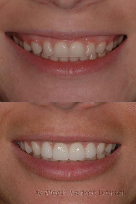 Gum Laser Surgery Before And After, Gum Lift, Dental Post, Gum Surgery, Pretty Teeth, Braces Tips, Dental Posts, Tooth Care, Dental Health Care