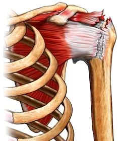 Torn Rotator Cuff Symptoms, Rotator Cuff Rehab, Shoulder Muscle Pain, Rotator Cuff Pain, Shoulder Anatomy, Rotator Cuff Exercises, Rotator Cuff Surgery, K Tape, Shoulder Dislocation