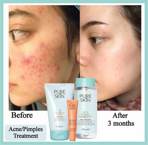 Pimples Quotes Inspiration, Pimples Quotes, Mens Shaving Cream, Oriflame Beauty Products, Pure Skin, Beauty Entrepreneur, Skin Care Tutorial, Acne Skin, Skin Treatments