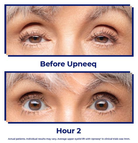 This New Eye Drop Lifts Droopy Eyelids Without Surgery - NewBeauty Eye Lid Lift Droopy Eyelids, Asymmetrical Eyes, Eye Lift Surgery, Drooping Eyelids, Droopy Eyelids, Eye Makeup Application, Droopy Eyes, Eyelid Lift, Eye Drop