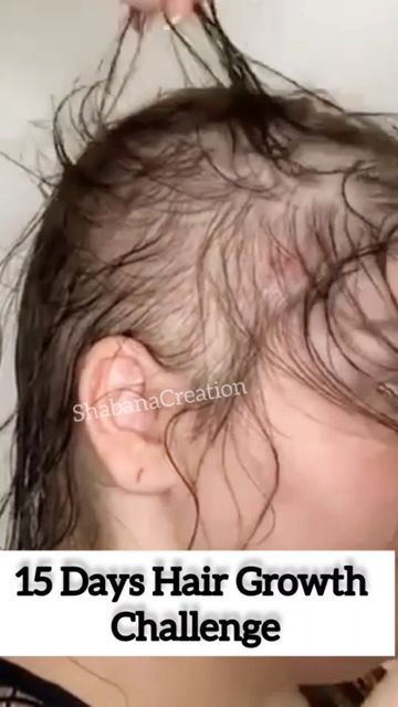 Hair Problems Solutions, Bald Hair Growth, Body Facts, Growth Challenge, Longer Hair Growth, Hair Growth Challenge, Hair Care Remedies, Natural Hair Diy, Hair Care Recipes