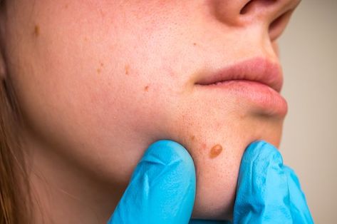 The Complete Guide to Basal Cell Carcinoma What Are Skin Tags, Remove Skin Tags, Remove Skin Tags Naturally, Basal Cell, Mole Removal, Health Articles Wellness, Skin Tags, Homemade Facials, Insect Bites