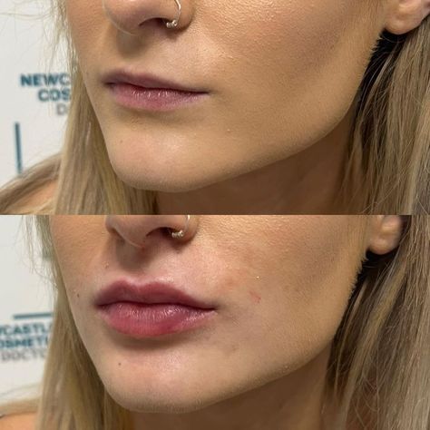 #plasticsurgery #plasticsurgerygonewrong #beforeafter #celebritiesbeforeafter #hollywoodstars #bignosesurgery #surgery #facesurgery #vlinesurgery #koreanplasticsurgery #kpopplasticsurgery #nosejob #jawreductionsurgery #eyesurgery #cheekfillers #rhinoplasty #facelift #plasticsurgeryfails #expensiveplasticsurgery Before And After Lip Fillers Small Lips, Lip Filler Smile Before And After, Lip Flip And Filler Before And After, Small Lip Injections, Lip Filler On Small Mouth, One Syringe Lip Filler, Healed Lip Filler, Volbella Lips Before And After, Lip Injections Before And After 0.5ml