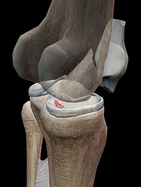 Do The Twist: A Look at a Torn Meniscus Meniscal Tear, Human Body Anatomy, Body Anatomy, Look At, Human Body, Twist, Human