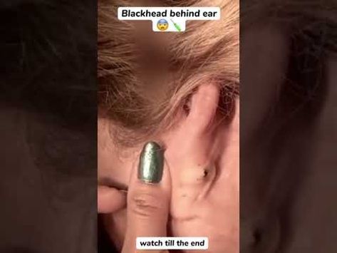 Blackhead Behind Ear #oddlysatisfying #sick #blackhead #pimplepopper #satisfying #cyst #wow #acne Blackheads Removal Cream, Closed Comedones, Ear Pimple, Big Pimple, Cystic Pimple, Cystic Acne Remedies, Dilated Pores, Blackhead Remover Diy, Remedies For Acne