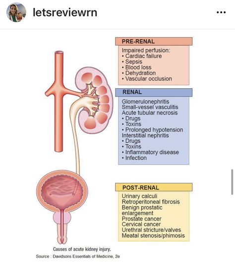 Acute Kidney Injury Nursing, Renal Calculi, Acute Kidney Injury, Nclex Prep, Study Biology, Pharmacy School, Pa School, Medical Studies, Nursing School Notes