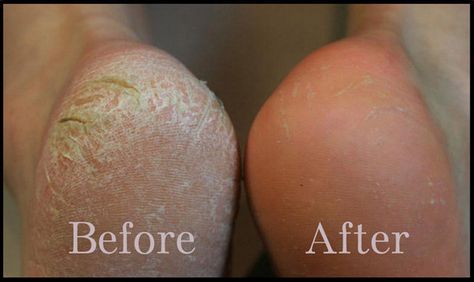 If you've got tons of dry, scaly skin on the bottoms of your feet, try a Baby Foot exfoliating mask. Dry Cracked Heels, Scaly Skin, Exfoliating Mask, Foot Soak, Cracked Heels, Callus Removal, Skin Problems, Diy Beauty, Dead Skin