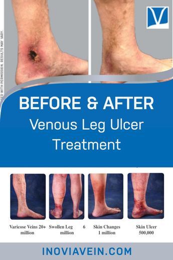 Venous leg ulcers are a type of chronic wound typically caused by underlying venous disease, which can lead to poor blood flow in the legs and ankles. Venous ulcers are often slow to heal and can be painful and debilitating, which can greatly impact a patient’s quality of life. Vein Health, Leg Ulcers, Varicose Vein Remedy, Venous Insufficiency, Leg Pain, Kitchen Design Plans, Natural Health Remedies, Quality Of Life, Health Education