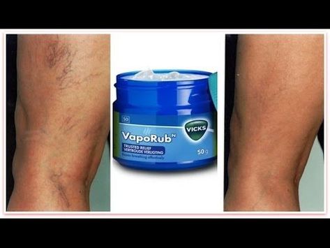 How To Use Vicks VapoRub To Get Rid Of Varicose Veins Fast | |Amazing Result |Marvet J. TV - YouTube Vericous Veins, Khichi Beauty, Vicks Vapor Rub, Varicose Vein Removal, Varicose Vein Remedy, Get Rid Of Spiders, Leg Veins, Vein Removal, Vapor Rub