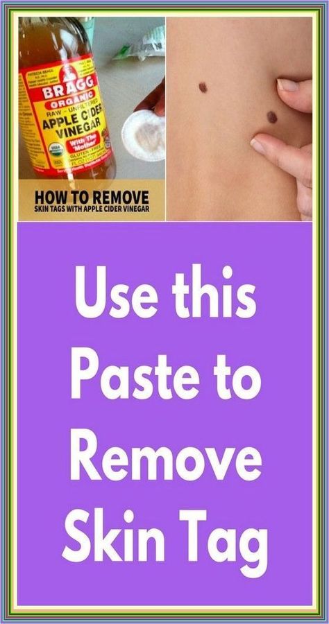 How to Remove Skin Tag in 1 Night Apple Cider Vinegar Uses, Remove Skin Tags, Remove Skin Tags Naturally, Mother Health, Unfiltered Apple Cider Vinegar, Vinegar Uses, Skin Tags, Organic Apple Cider, Organic Apple Cider Vinegar