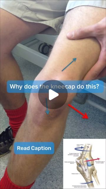 Mr Paul Trikha | Specialist Knee Surgeon on Instagram: "‘Knee Cap dislocation’- Patella Instability.   RISK FACTORS:.  ❇️ “miserable malalignment syndrome” leads to an increased Q angle   Q angle: a measure of the resultant lateral pull on the patella ( between Quadriceps and patella tendon)   - 3 anatomic characteristics  🦵🏽Femoral Anteversion  🦵🏽Valgus (Knock Knee)  🦵🏽external tibial torsion / pronated feet  ❤️ Like the post 🏷 Tag a friend ✈️ Share  ✉️ Comment below 📥 DM  .  Follow 👉 @surreykneesurgeon . #aclrecovery #kneepain #acl #aclsurgery #aclrecovery #jump #squat#run #runner #quads #fyp #gym #kneepain #acl #aclsurgery #aclrecovery #jump #squat#run #runner #quads #fyp #gym #kneepain#footballer #aclreconstruction#sports #kneesurgeon #football #kneesurgery #acliniury #kneespe Acl Recovery, Knee Ligaments, Acl Surgery, Knock Knees, Knee Cap, Knee Surgery, Run Runner, Sports Injury, Knee Injury