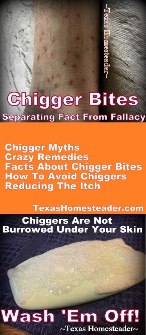 Avoiding Chiggers, Relieving Itching & Old Wives Tale Remedies. ~ Texas Homesteader ~ Chiggers Remedy, Chigger Bite Remedy, Homesteading Inspiration, Survival Preparedness, Old Wives Tale, Natural Repellent, Ant Killer, Homestead Ideas, Skin Washing