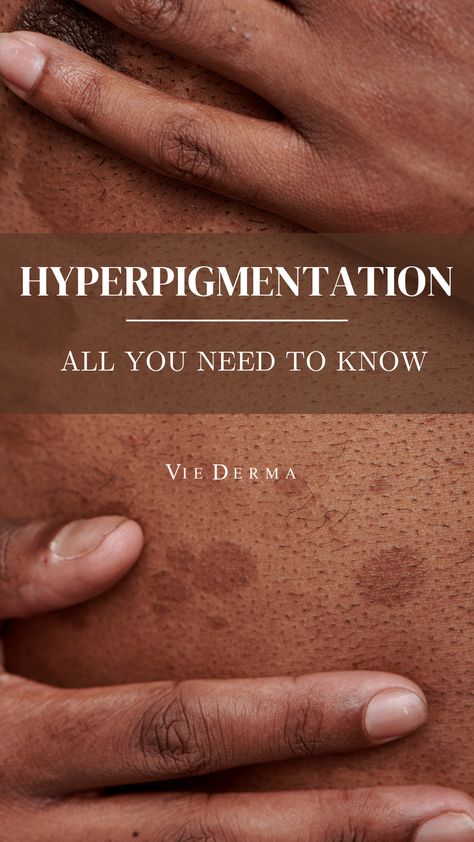 Best Skincare For Hyperpigmentation, Faded Hyperpigmentation Cream, Skincare Hyperpigmentation, Treat Hyperpigmentation, Treating Hyperpigmentation, Post Inflammatory Hyperpigmentation, Hydra Facial, Serious Skin Care, Skin Condition