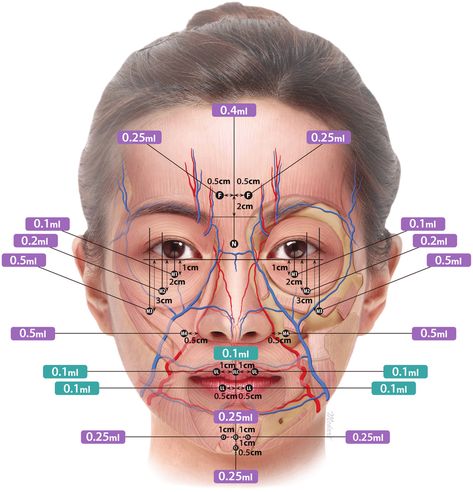 Small Chin, Face Injections, Botox Injection Sites, Filler Injection, Facial Injections, Face Fillers, Botox Lips, Hyaluronic Acid Fillers, Facial Anatomy