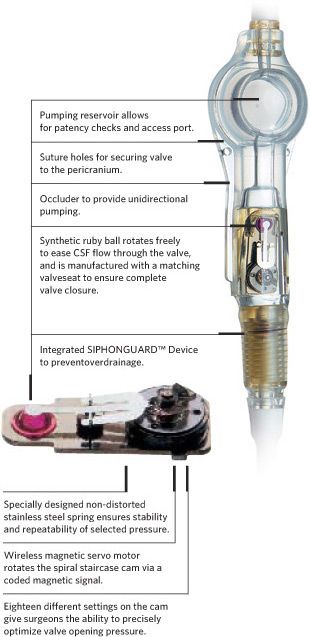 Codman Valve Vp Shunt, Spinal Fluid, Spina Bifida, Cerebrospinal Fluid, Chiari Malformation, Brain Surgery, Brain Function, Migraine, Headache