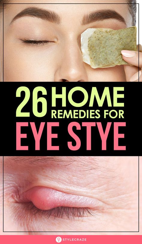 Sty In Eye Remedies, Get Rid Of Stye, Stye Remedy, Eye Stye Remedies, Home Remedies For Bronchitis, Swollen Eyes, Eye Infections, Home Remedy For Cough, Cold Sores Remedies