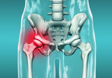 Hip Socket Fractures -- "Acetabular Fractures" Hip Fracture, Pelvic Bone, Bone Fracture, Hip Surgery, Bone Loss, Bone Density, Hip Pain, Medical History, Surgery