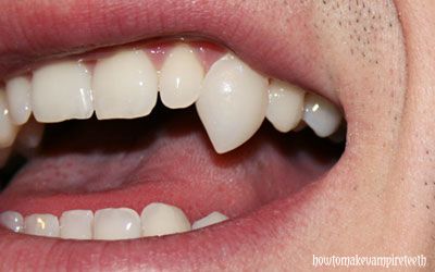 how-to-make-vampire-teeth-v1-one-fang-tn Fang Implants, Fang Teeth, Natural Fangs, Fang Veneers, Straight Teeth With Fangs, Vampire Teeth Body Mod, Vampire Fang Grill, Diy Fangs Vampire Teeth, Heart Shaped Fangs Teeth