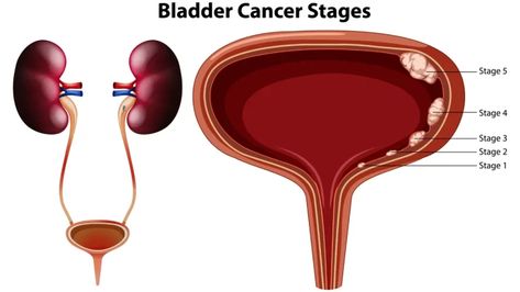 Nephroblastoma (Wilm's tumor), Risk factors of Urothelial tumors (Tumors of transitional epithelium) Transitional Epithelium, Wilms Tumor, Brain Shape, Renal Cell Carcinoma, Protein Metabolism, Squamous Cell