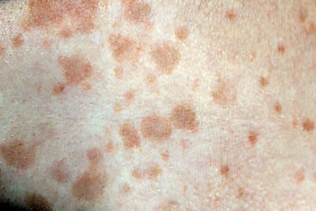 Tinea versicolor: Overview Yeast Infection On Skin, Tinea Versicolor, Learning Techniques, Large Pores, Enlarged Pores, Skin Diseases, Deep Wrinkles, Dermatologist Recommended, General Information