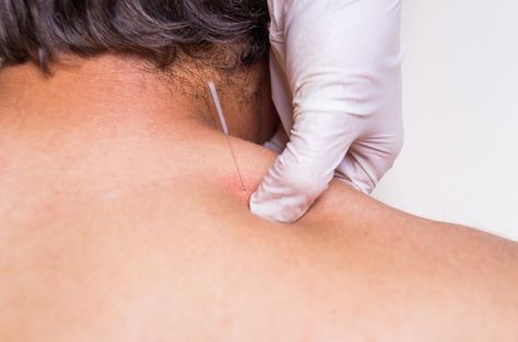 Dry needling vs. acupuncture: Benefits and uses Women Tattoo For Men, Dry Needling Therapy, Tattoo Painful Chart, Tattoo Numbers, Hand Pressure Points, Tattoo Filler Ideas, Tattoo For Kids, Numbers Tattoo, Tattoo Eyebrows