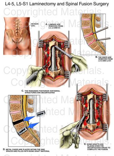 L4-5, L5-S1 Laminectomy and Spinal Fusion Surgery : Medical Chart Medical Diagrams, L5 S1, Spinal Fusion Surgery, Medical Projects, Spinal Fusion, Spinal Surgery, Hip Problems, Spine Health, Spine Surgery