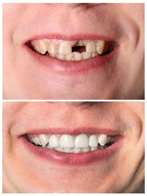 If you have a damaged or decayed tooth, your dentist may recommend chairside dental restoration. Our dental practice offers a variety of tooth restoration dental services, including crowns, bridges, and dental implants. Dental Bonding, Dental Restoration, Dental Exam, Dental Fillings, Dental Facts, Restorative Dentistry, Emergency Dentist, Teeth Implants, Dental Bridge