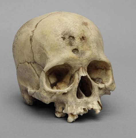 Bone Clones cast of a human skull with syphilis. (Image by Bone Clones on wikimedia commons, used under a CC BY-SA 3.0 license.) Bone Reference, Female Skull, Skull Anatomy, Forensic Anthropology, Skull Reference, Human Skeleton, Forensic Science, 2nd Year, Human Male