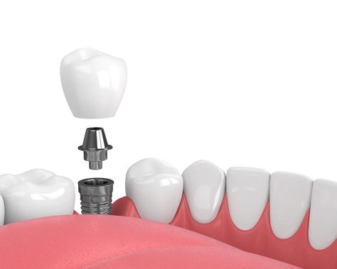 Here's what to expect during your dental implant recovery and what you can do to help shorten the timeline by promoting healing in Marrero. Dental Animation, Dental Implant Surgery, Dental Aesthetics, Bone Grafting, Medical Animation, Aesthetic Dentistry, Teeth Implants, Dental Implant, Jaw Bone