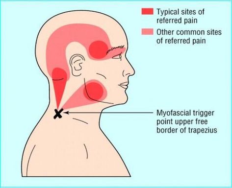 Nerve Pain Remedies, Punkty Spustowe, Tmj Relief, Myofascial Pain Syndrome, Referred Pain, Natural Pain Relievers, Jaw Pain, Trigger Point Therapy, Nerve Pain Relief