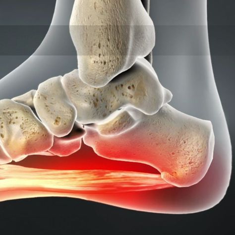 Plantar fasciitis is the most common cause of heel pain and the most common reason for visiting an orthopedic surgeon for foot pain. Plantar fasciitis pain is caused by inflammation of the thick tissue located on the bottom of your foot, just behind your heel. The condition typically develops gradually, with symptoms ranging from mild to severe. Plantar fasciitis is also sometimes called "heel spur syndrome" since a heel spur is often present in those with more… Heel Spur, Heel Spur Relief, Dry Needling, Gel Pack, Heel Pain, Foot Pain, Pain Free, Reduce Inflammation, Pain Relief